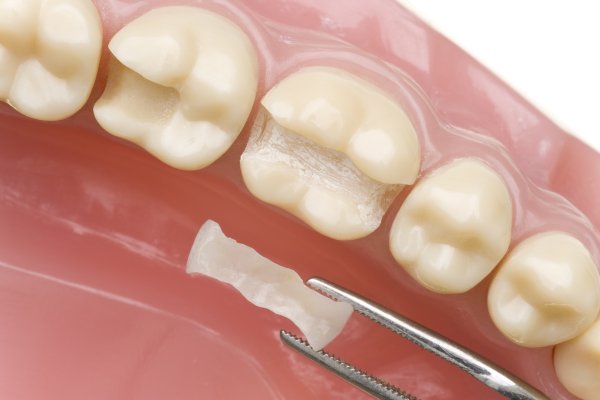 Ways Dental Sealants Help Keep Teeth Cavity Free