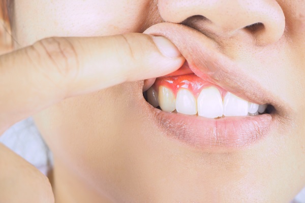 What Are The Signs Of Gum Disease?