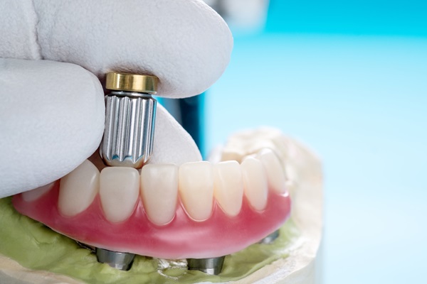 Why You Should Choose Implant Supported Dentures